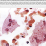 warthin_findelkey_cells.png