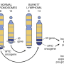 burkitts_lymphoma.png