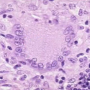 langhans_giant_cell.png